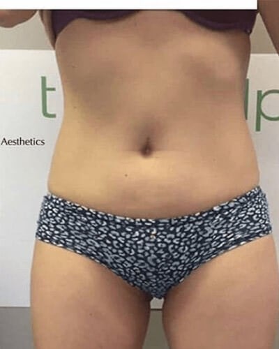trusculpt before and after image