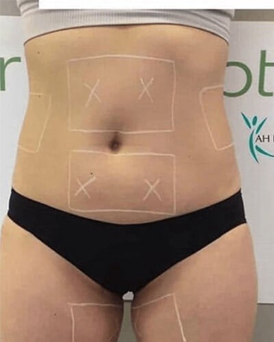 trusculpt before and after image