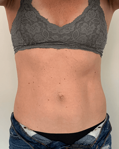 trusculpt before and after image