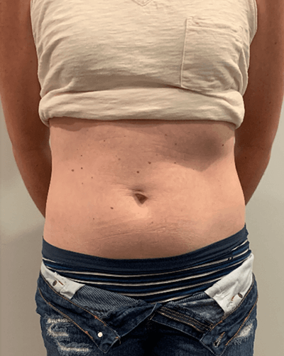 trusculpt before and after image